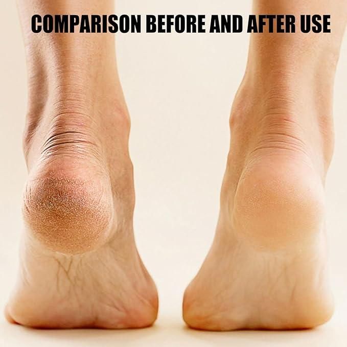 Rechargeable Callus Remover Pedicure Device for Women - Foot Scrubber for Dead Skin (pedicure machine)